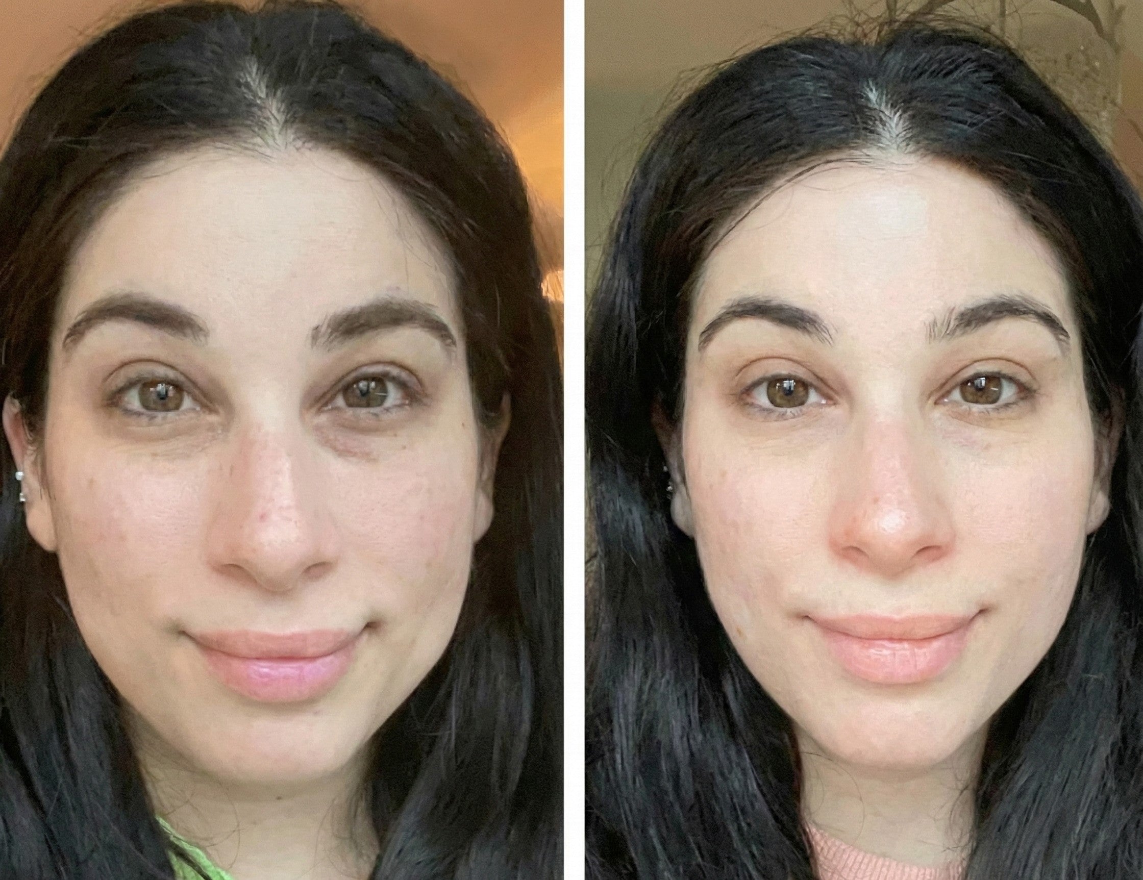 Avant / après utilisation de Lumirel sur le contour de l’œil